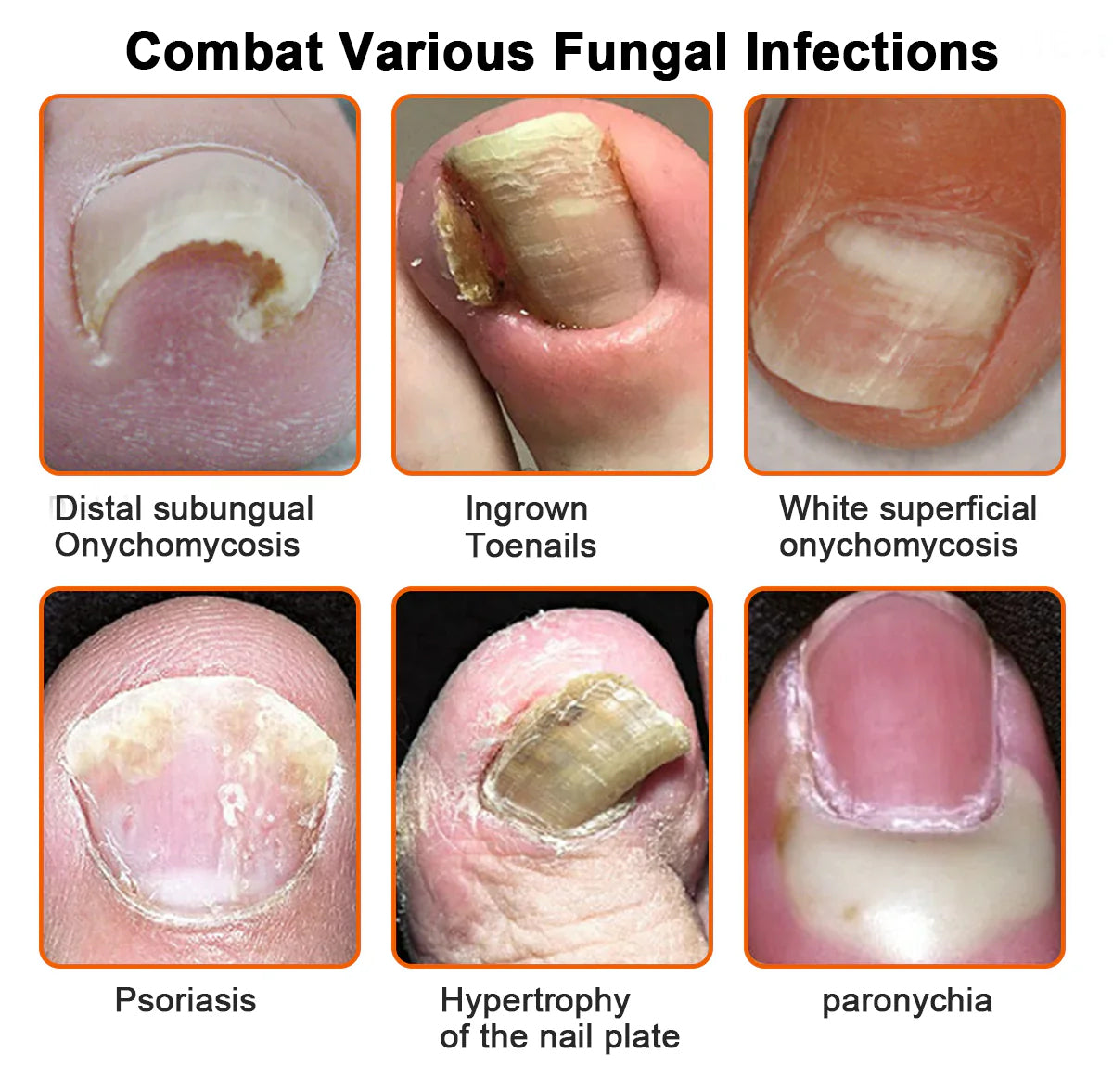 🐝🐝 LBMLBM™ Bee Venom Nail Fungus Treatment Solution: A Complete Solution to Nail Fungus🌟👣