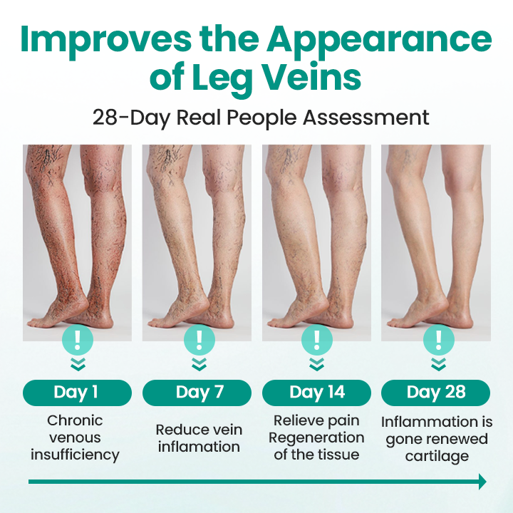 LBMLBM® LegRenew Varicose Veins Patch – The Ultimate Solution for Smooth, Healthy Legs and Varicose Vein Relief!