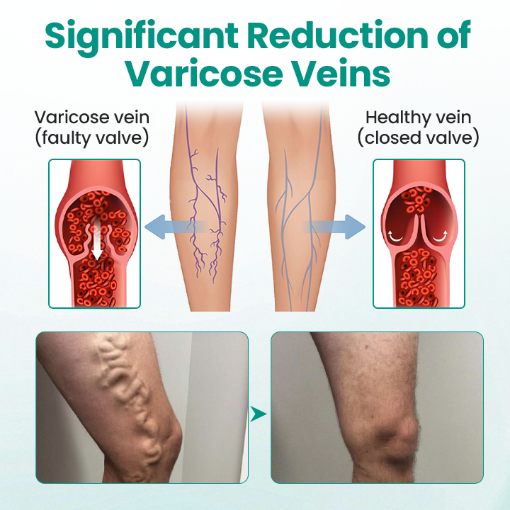 LBMLBM® LegRenew Varicose Veins Patch – The Ultimate Solution for Smooth, Healthy Legs and Varicose Vein Relief!