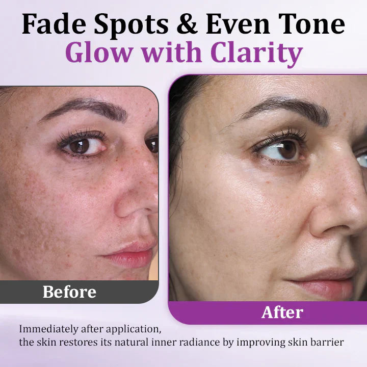 ✨ Advanced Anti-Hyperpigmentation Essence – Fade Dark Spots, Even Skin Tone & Boost Radiance in Just 2 Weeks! 🌟