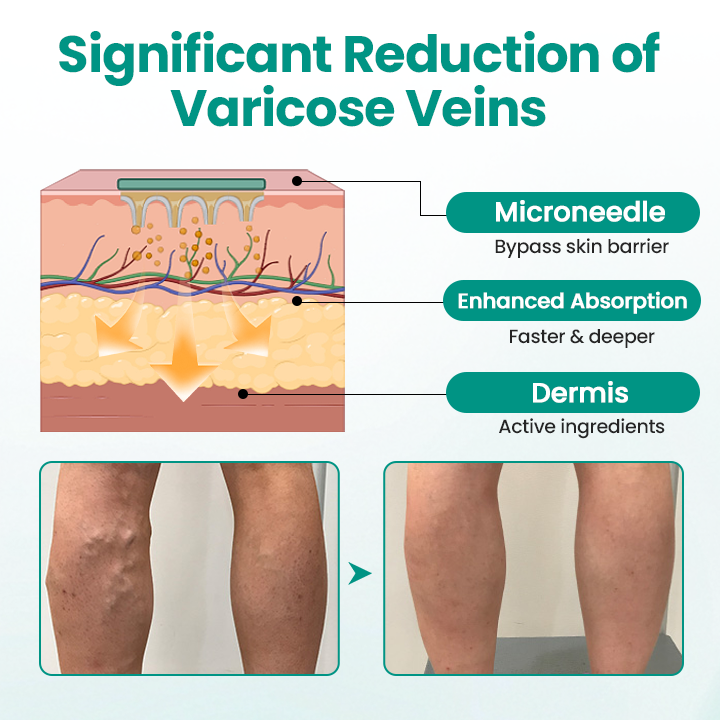 LBMLBM® LegRenew Varicose Veins Patch – The Ultimate Solution for Smooth, Healthy Legs and Varicose Vein Relief!