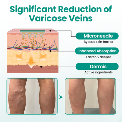 LBMLBM® LegRenew Varicose Veins Patch – The Ultimate Solution for Smooth, Healthy Legs and Varicose Vein Relief!
