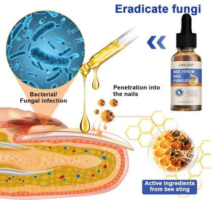 🐝🐝 LBMLBM™  Bee Venom Nail Fungus Treatment Solution: A Complete Solution to Nail Fungus🌟👣