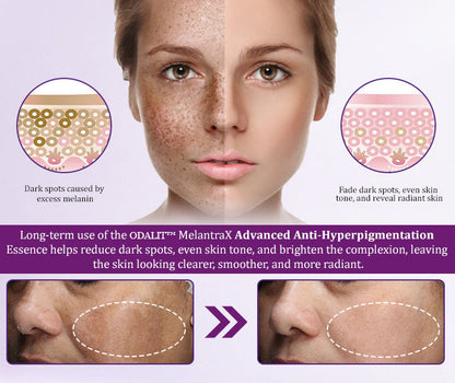 ✨ Advanced Anti-Hyperpigmentation Essence – Fade Dark Spots, Even Skin Tone & Boost Radiance in Just 2 Weeks! 🌟