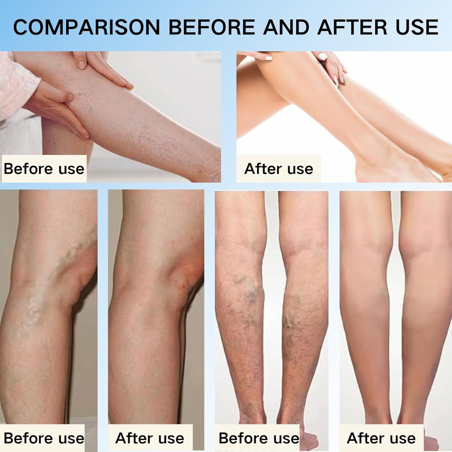 🔥NOW 50%OFF🔥-Veinhealing Varicose Veins Treatment Spray