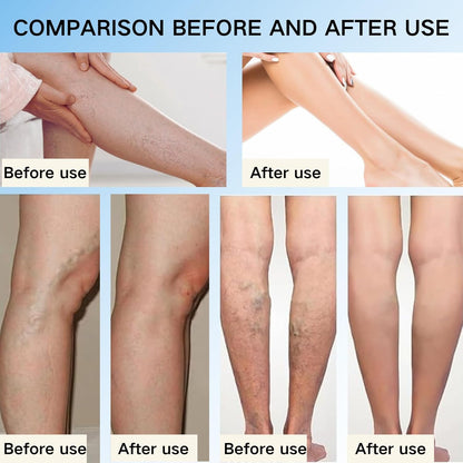 🔥NOW 50%OFF🔥-Veinhealing Varicose Veins Treatment Spray